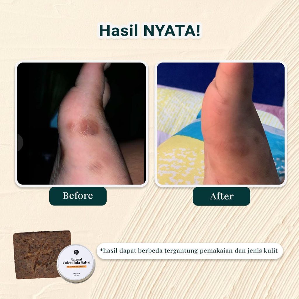 Before-After Bundle Bekas Luka2