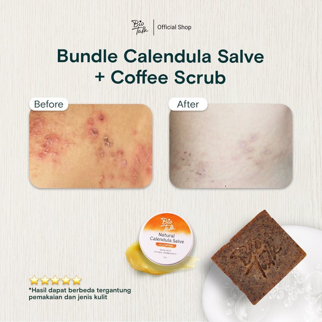 Before-After Bundle Bekas Luka4