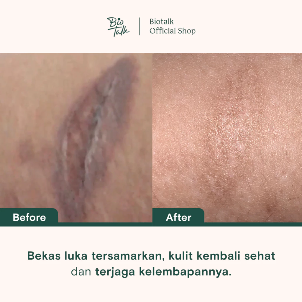 SKU Bundle bekas luka-2